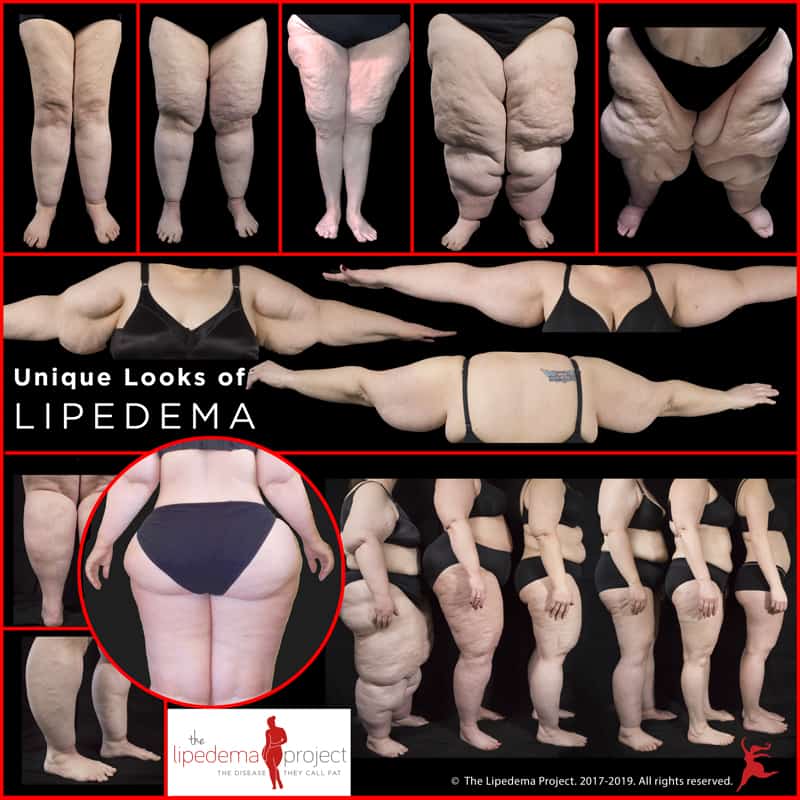 Lipedema Legs or Just Fat Legs? Crucial Things to Know - Salameh