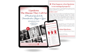 Lipedema The Disease They Call Fat. A practical guide to the Characteristics, Stages, and Types