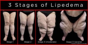 About Lipedema - Three stages of Lipedema that shows what leg look like for every stage